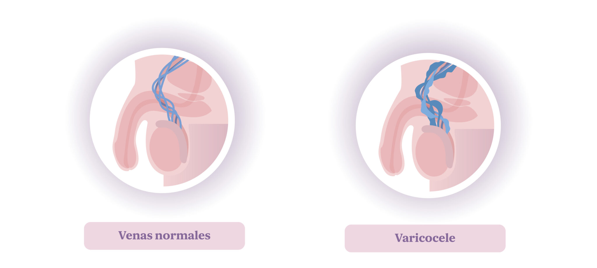 Varicocee Varicocele y fertilidad masculina: causas, diagnóstico y tratamiento