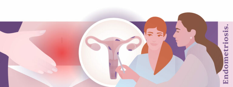 Endometriosis