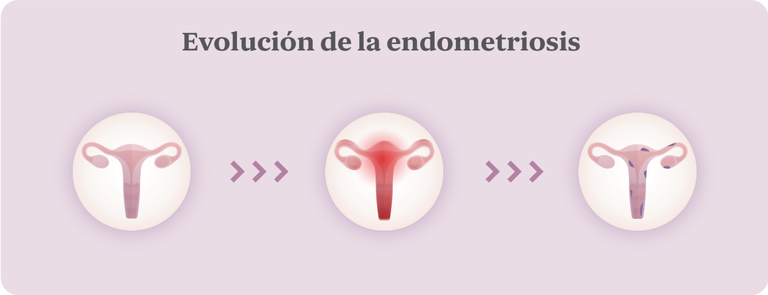 Endometriosis: claves para entender la enfermedad - Next Fertility