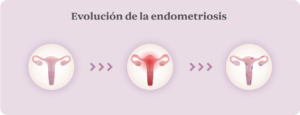 Evolución de la endometriosis