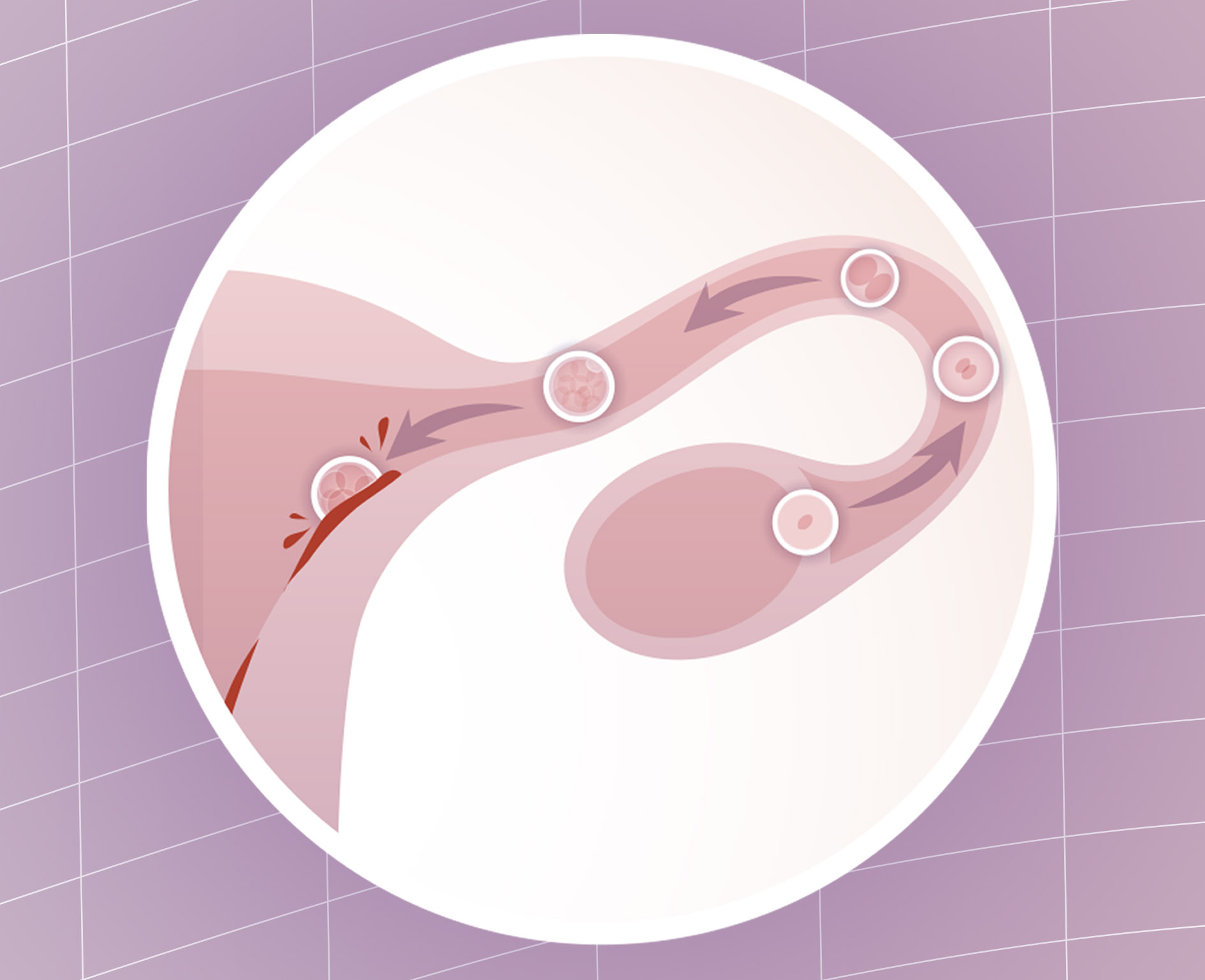Aceptado Prueba de Derbeville izquierda Sangrado de implantación: por qué sucede y cómo identificarlo - Next  Fertility