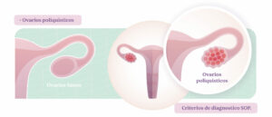 Ovarios poliquisticos debido al sindrome de ovarios poliquisticos SOP