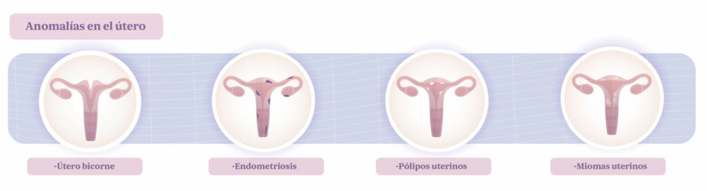 Esterilidad: anomalías en el útero