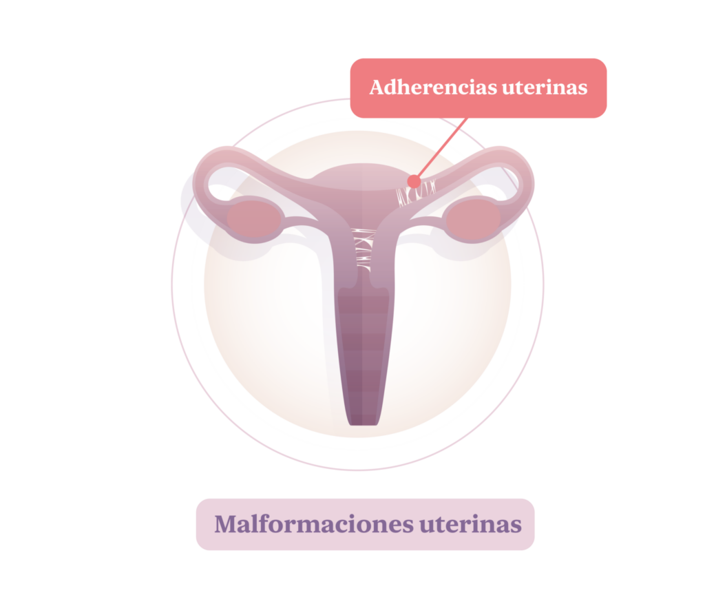 Adherencias intrauterinas que puede provocar un aborto