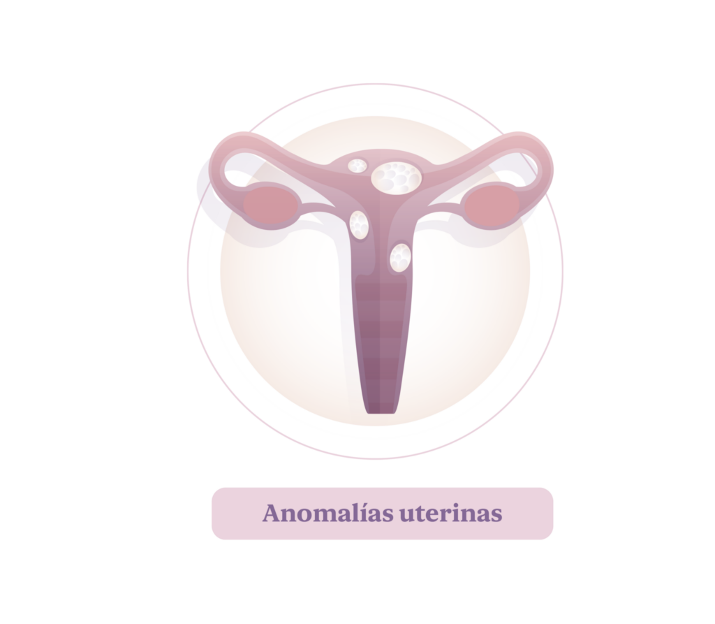 Aborto. Anomalías uterinas.