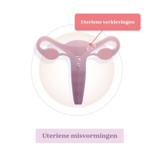 Verklevingen baarmoeder miskraam