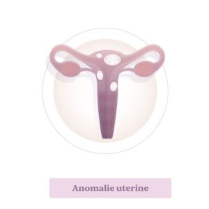 Aborto. Anomalie uterine