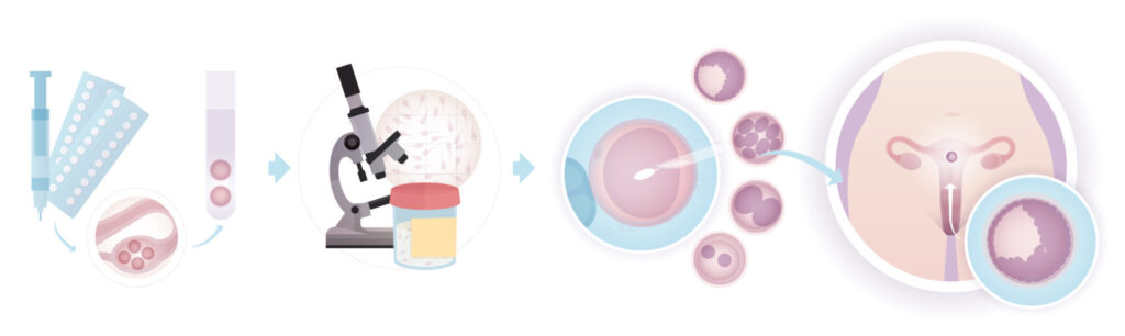 Fecundación in vitro paso a paso