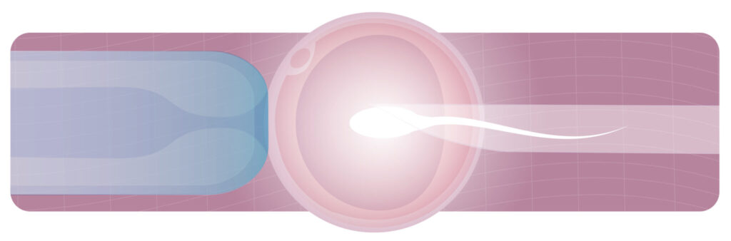 Embarazo por fecundación in vitro