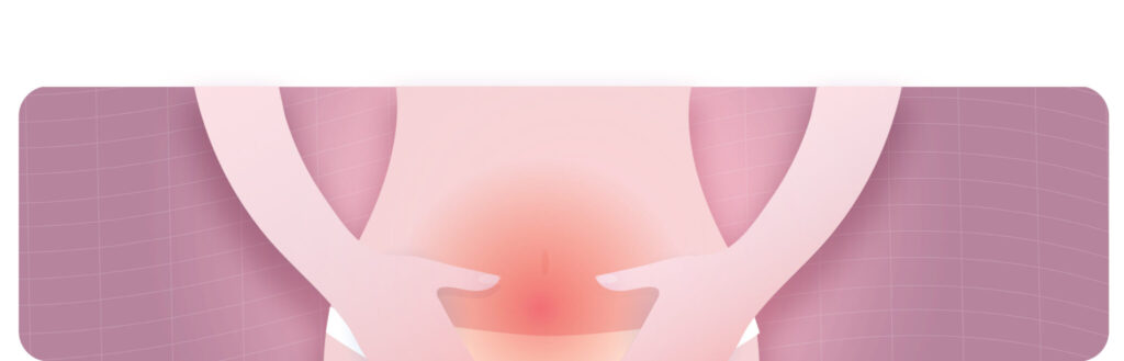 Hernia umbilical
