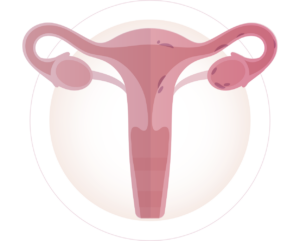 Endometriosis