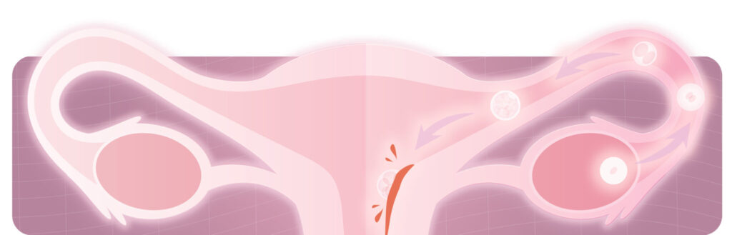 sangrado de implantacion
